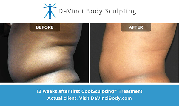 Davinci Body Sculpting – CoolSculpting is All We Do – Swoon Memorial